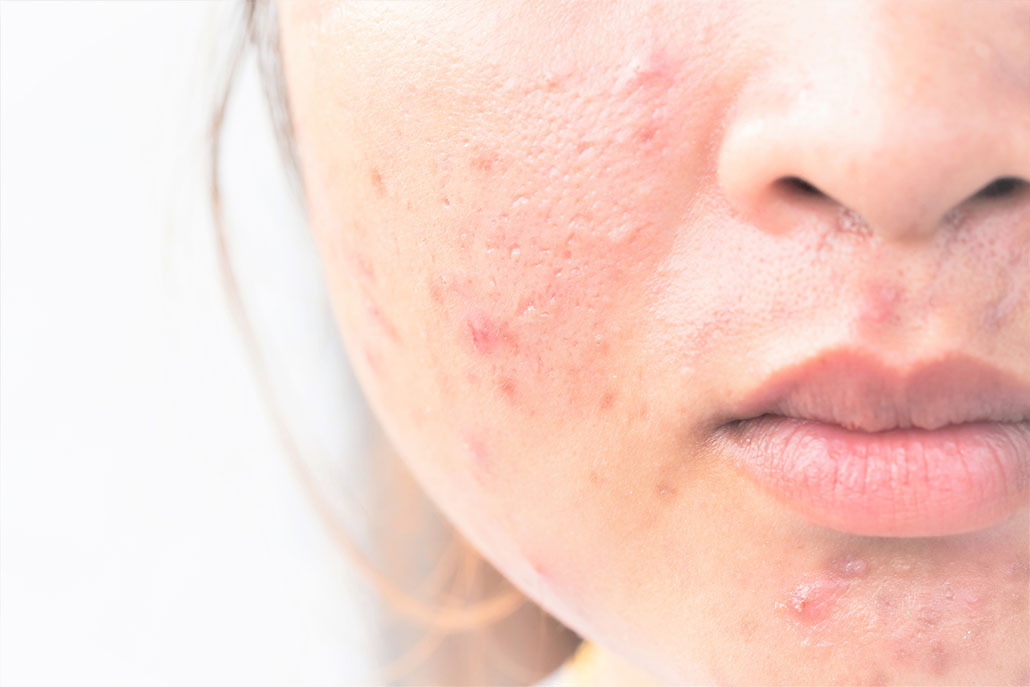 Junge Frau mit Akneproblem im Gesicht