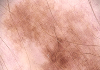 Sequentielle Dermatoskopie – gewachsene Pigmentläsion am rechten Oberschenkel 2022 Kontrollaufnahme einer deutlich gewachsenen, asymmetrischen Pigmentläsion am rechten Oberschenkel im Juni 2022.