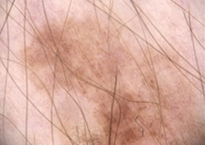 Sequentielle Dermatoskopie – Pigmentläsion am rechten Oberschenkel 2020 Dermatoskopische Ausgangsaufnahme einer Pigmentläsion am rechten Oberschenkel einer 64-jährigen Patientin im Dezember 2020.