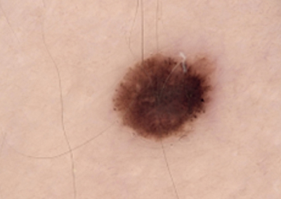 Sequentielle Dermatoskopie – vergrößertes Pigmentmal am rechten Oberarm Kontrollaufnahme eines deutlich vergrößerten und asymmetrischen Pigmentmals am rechten Oberarm.