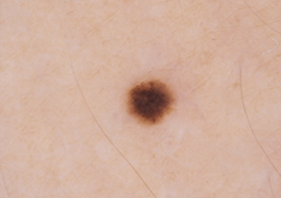 Sequentielle Dermatoskopie – Pigmentmal am rechten Oberarm vor der Veränderung Frühere dermatoskopische Aufnahme eines kleinen Pigmentmals am rechten Oberarm einer 38-jährigen Patientin.