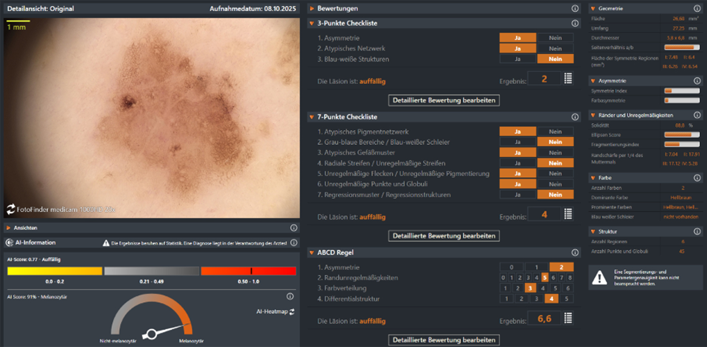 Softwareansicht des MoleAnalyzer Pro mit dermatoskopischer Aufnahme einer Pigmentläsion sowie Analyse von Geometrie, Farbe, Struktur und etablierten Bewertungsscores.