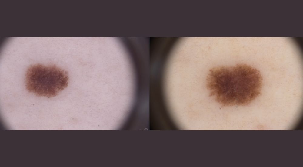 Pigmentmal im zeitlichen Verlauf – digitale Dermatoskopie Zwei dermatoskopische Vergleichsaufnahmen eines Pigmentmals zur Beurteilung von Veränderungen in Größe, Farbe und Struktur.