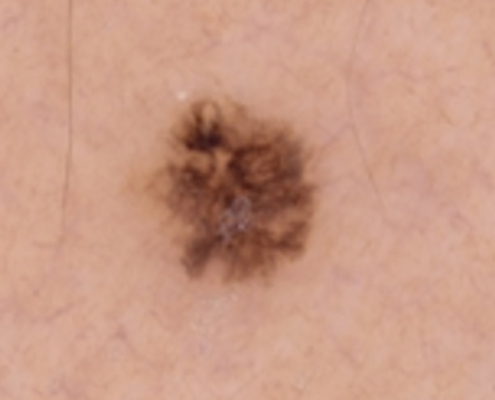 Sequentielle Dermatoskopie – verändertes Pigmentmal am rechten Oberarm 2022 Kontrollaufnahme des Pigmentmals am rechten Oberarm mit leichter Größenzunahme und veränderter Pigmentstruktur.