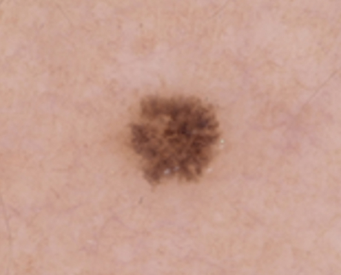 Sequentielle Dermatoskopie – Pigmentmal am rechten Oberarm 2021 Dermatoskopische Aufnahme eines Pigmentmals am rechten Oberarm einer 34-jährigen Patientin im März 2021.
