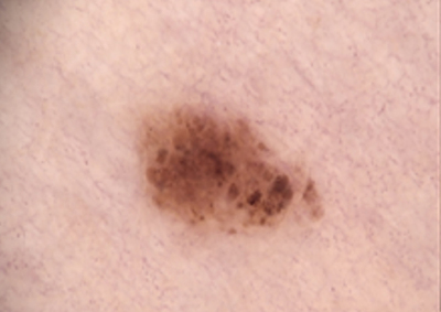 Sequentielle Dermatoskopie – gewachsene Läsion am rechten Oberschenkel 2022 Kontrollaufnahme einer deutlich gewachsenen, asymmetrischen Pigmentläsion am rechten Oberschenkel im April 2022.