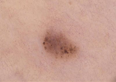 Sequentielle Dermatoskopie – Läsion am rechten Oberschenkel 2019 Dermatoskopische Ausgangsaufnahme einer pigmentierten Läsion am rechten Oberschenkel einer 79-jährigen Patientin im Juni 2019.
