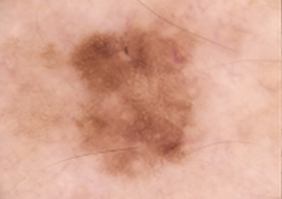 Sequentielle Dermatoskopie – strukturell verändertes Muttermal am Rücken 2022 Kontrollaufnahme des Muttermals am Rücken mit geringer Größenzunahme und deutlicher Strukturveränderung.