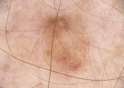 Sequentielle Dermatoskopie – Muttermal am Rücken 2020 Dermatoskopische Aufnahme eines sechs Millimeter großen Muttermals am Rücken eines 63-jährigen Patienten im Dezember 2020.