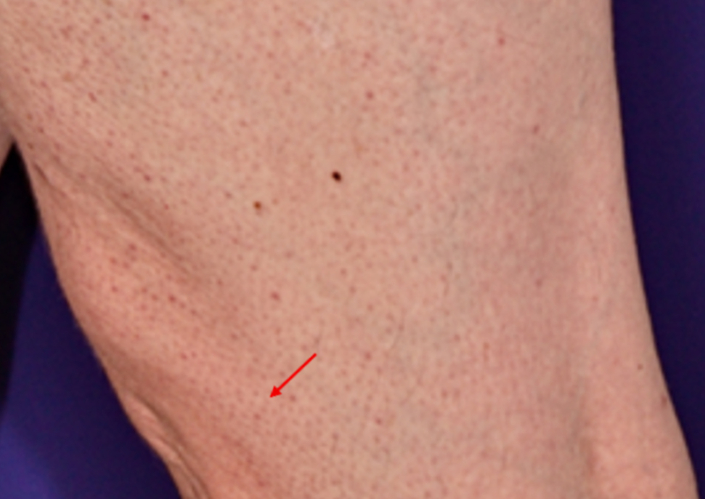 Total-Bodymapping-Aufnahme des linken Knies einer 55-jährigen Patientin im Jahr 2021, noch ohne erkennbare neue Läsion.