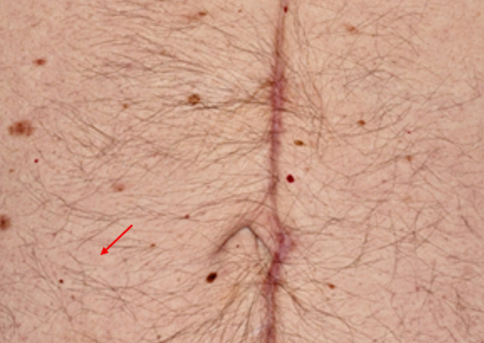 Total-Bodymapping-Aufnahme des rechten Unterbauchs eines 68-jährigen Patienten im Jahr 2020 mit einer zunächst kaum erkennbaren Läsion.