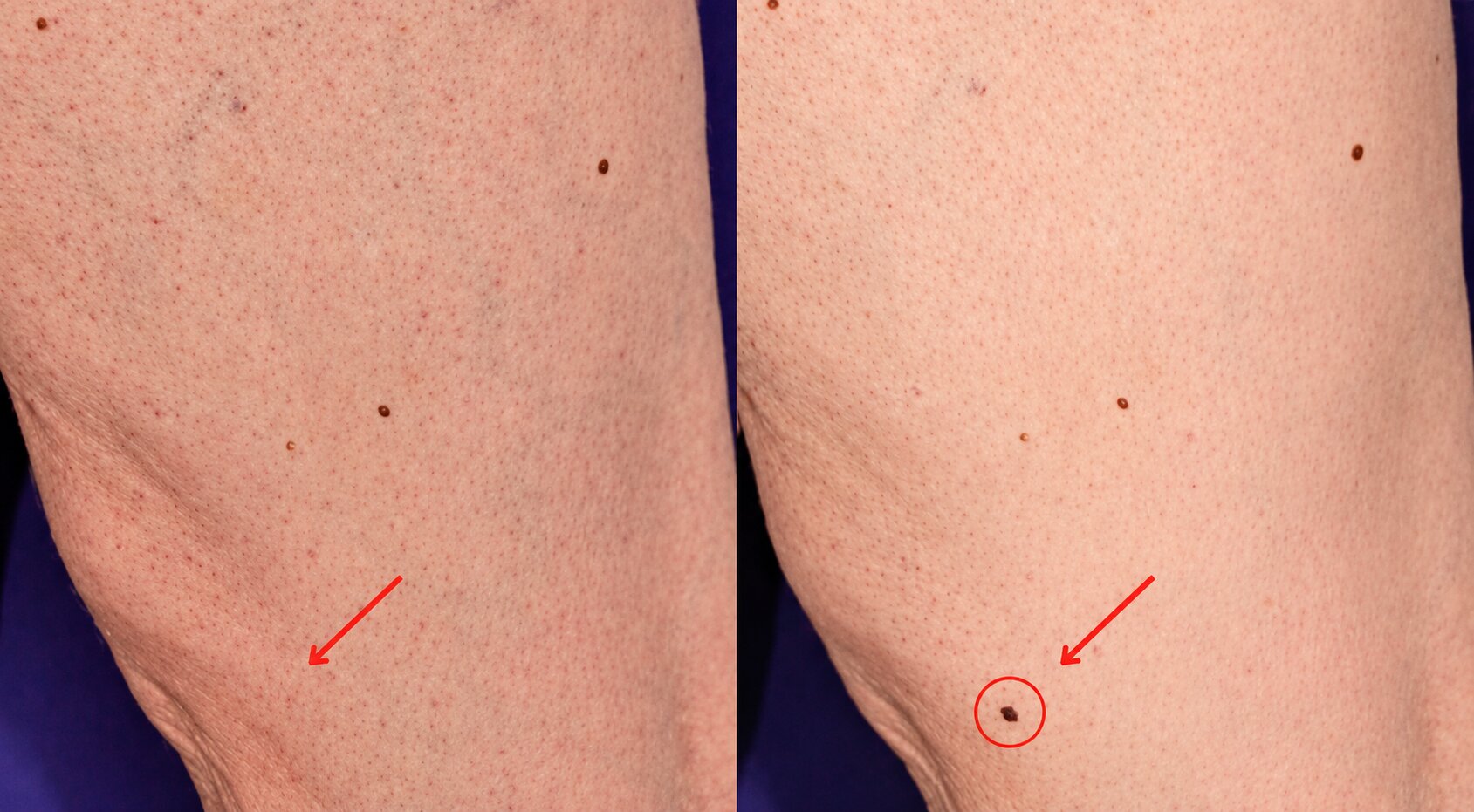 Total Bodymapping zur Erkennung einer neu entstandenen Läsion Vergleich zweier Ganzkörperaufnahmen mit einer neu entstandenen, durch Pfeil und Kreis markierten Hautläsion.